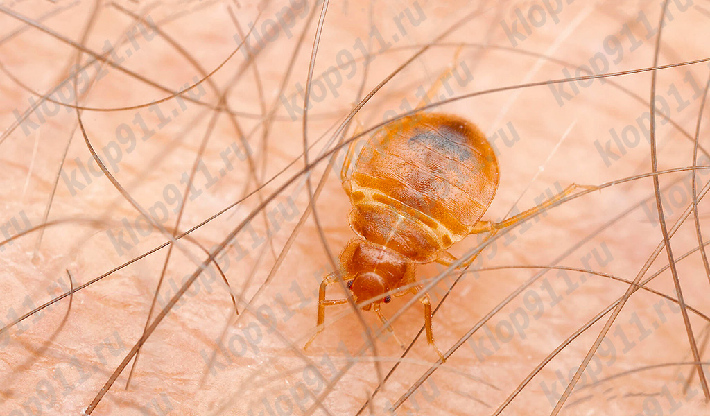 Blakės ant žmogaus odos